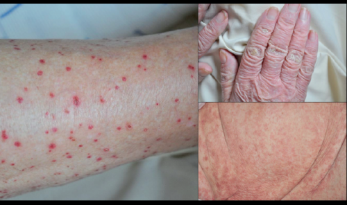 Archives des Pemphigoïde bulleuse Repères en Gériatrie