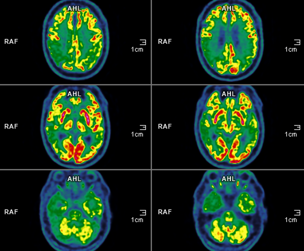 Acheter Qu'attendre de l'imagerie métabolique dans l'exploration des pathologies neurodégénératives de la personne âgée ? Qu'attendre de l'imagerie métabolique dans l'exploration des pathologies neurodégénératives de la personne âgée ?