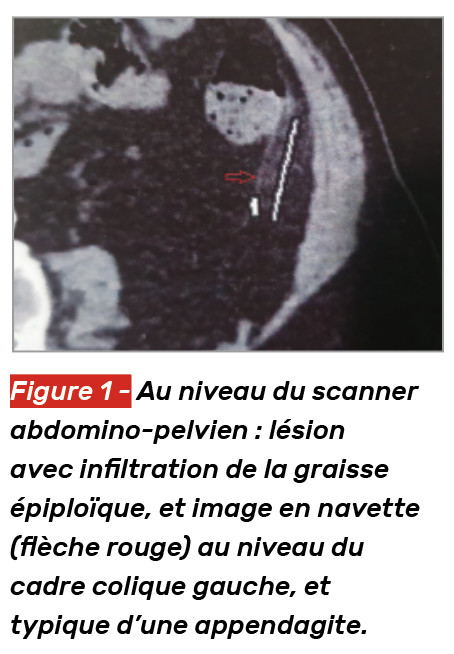 douleur cadre colique gauche